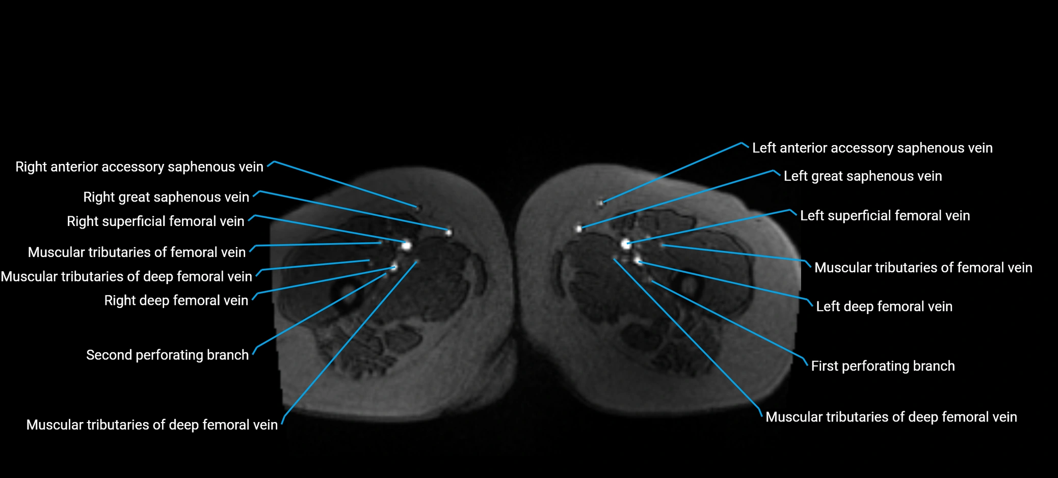 MRV abdomen pelvis & lower limb axial cross sectional anatomy labelled MRI image 226 (1).webp